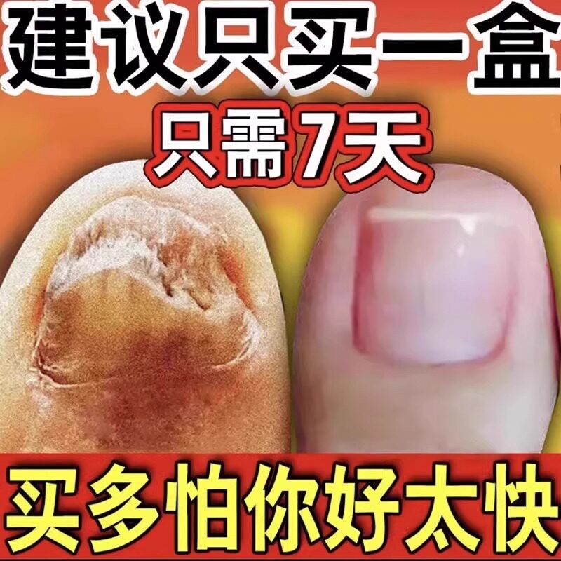 甲家乐护甲液修甲灰甲克星凤仙花抑菌液草本灰指甲正品官方旗舰店