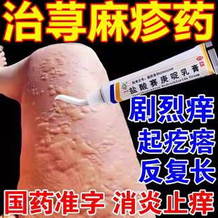 荨麻疹药膏慢性寻荨麻疹过敏止痒盐酸赛庚啶乳膏急性荨麻疹风团型
