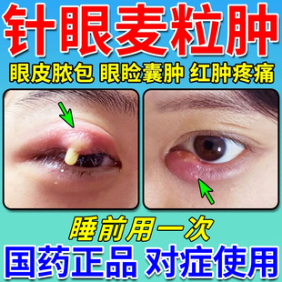 麦粒肿眼药膏消炎药霰粒肿针眼消肿细菌性结膜炎盐酸金霉素眼膏