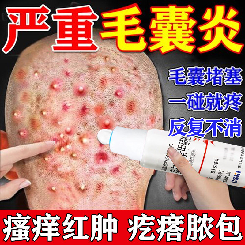 治毛囊炎专用药膏头皮头面部痤疮痘痘毛囊炎脂溢性皮炎痒酒糟鼻w