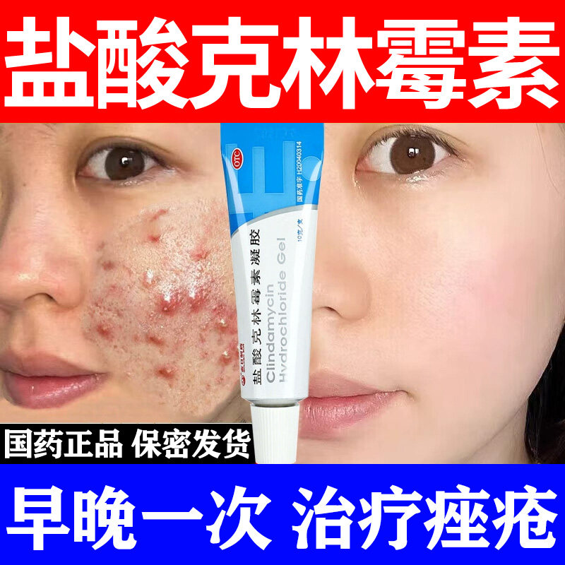 官方正品OTC盐酸克林霉素凝胶医用治疗痤疮祛痘痘软膏祛痘印药膏W