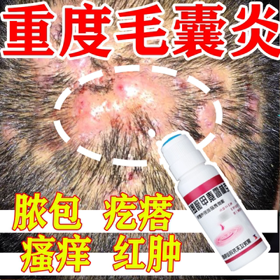 【天龙】克林霉素甲硝唑搽剂0.8%1%*40ml*1瓶/盒