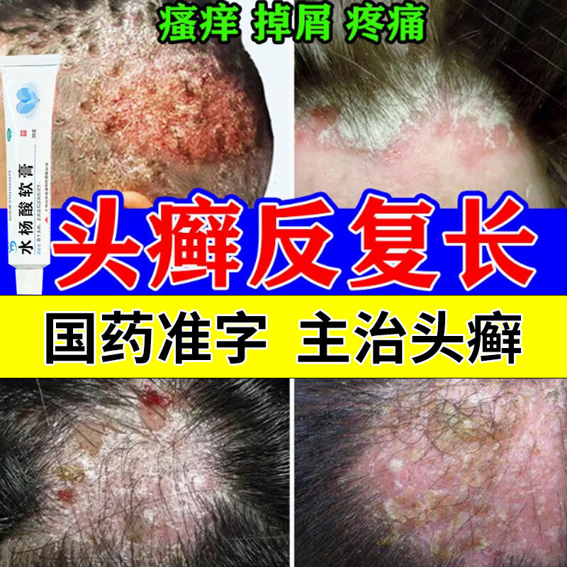 国药OTC头癣药膏治头部真菌感染头癣头痒红斑头屑多专用抗菌药膏