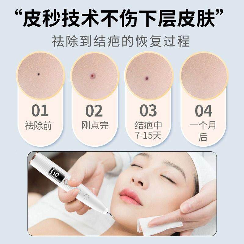 点痣笔美容院好专用激小白扫斑点痣笔扁平光疣仪器点斑消祥医堂痣