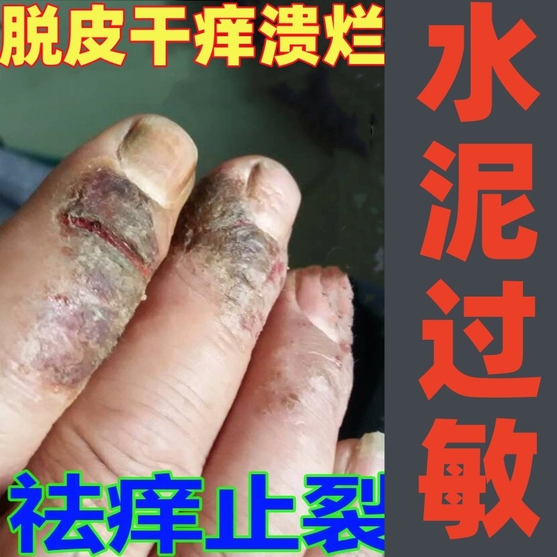 治水泥过敏建筑专用手痒起水泡皮肤瘙痒干裂脱皮止痒长藓外用药膏
