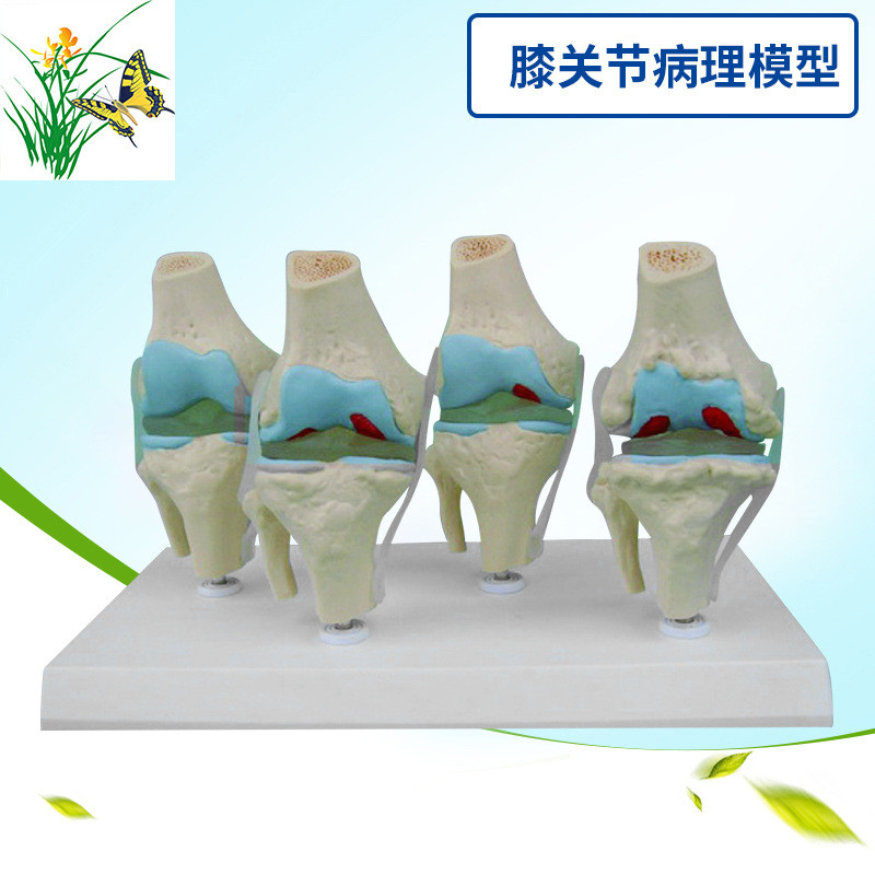 膝关节病模型 关节骨质病态展示人体膝关节病变模型带说明卡