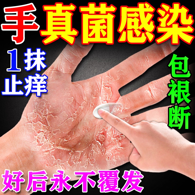 日本进口正品专研】手藓真菌感染