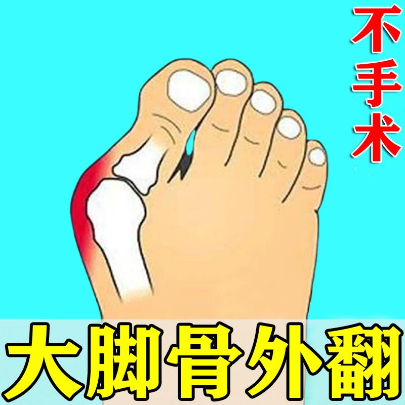 【脚不凸】拇指矫器外翻脚正趾重叠防磨大脚骨外翻拇指突出外翻贴