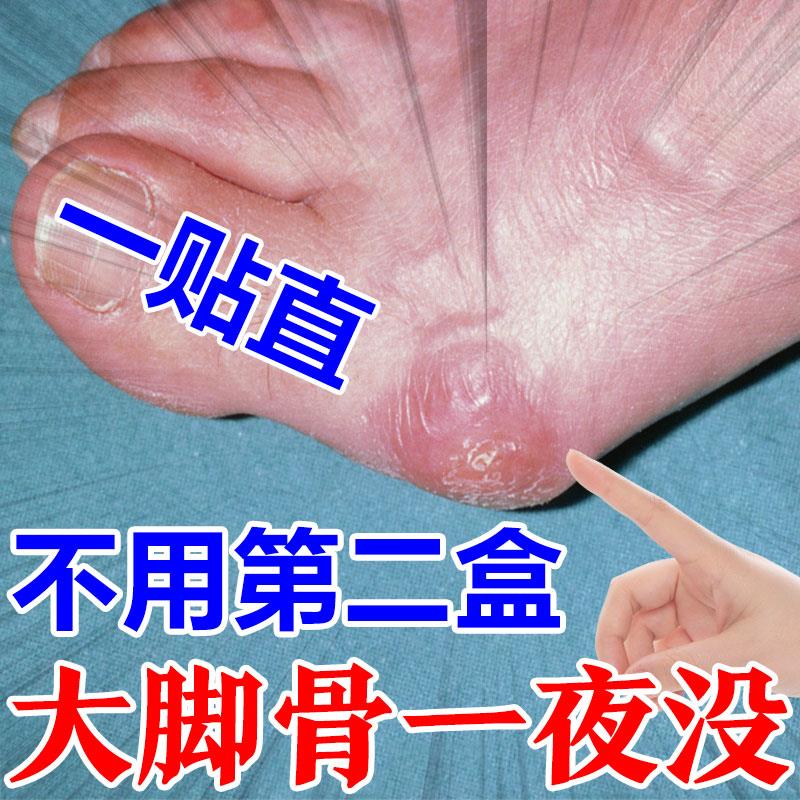 拇指外翻药膏贴大脚骨变形矫正脚趾重贴脚骨拐大拇指关节疼专用药