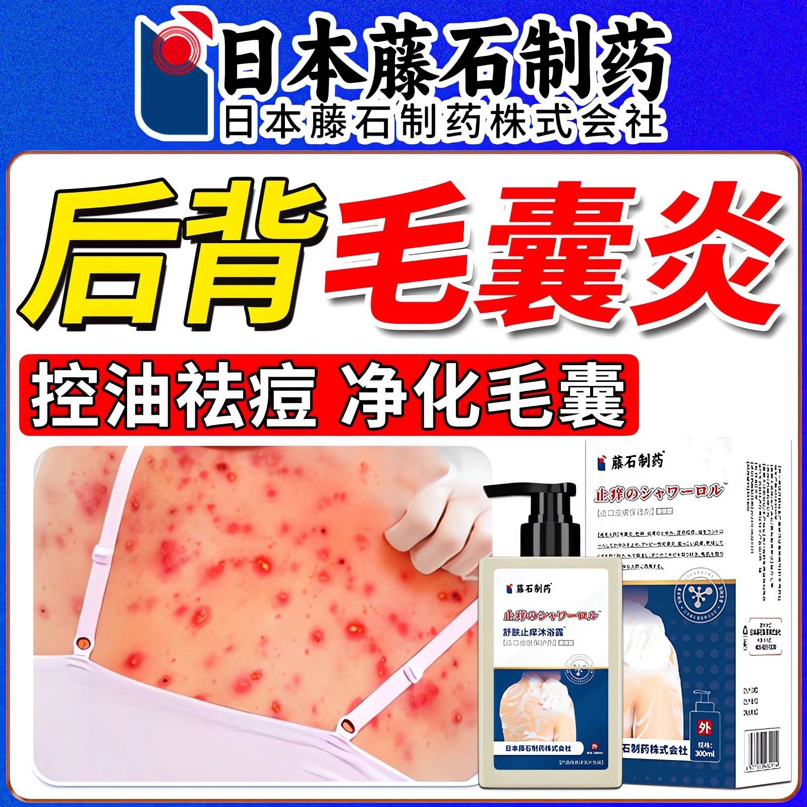 胸后背痘痘囊炎沐浴露YAH前后背馬長(zhǎng)毛拉色菌除螨祛痘止癢藥膏噴