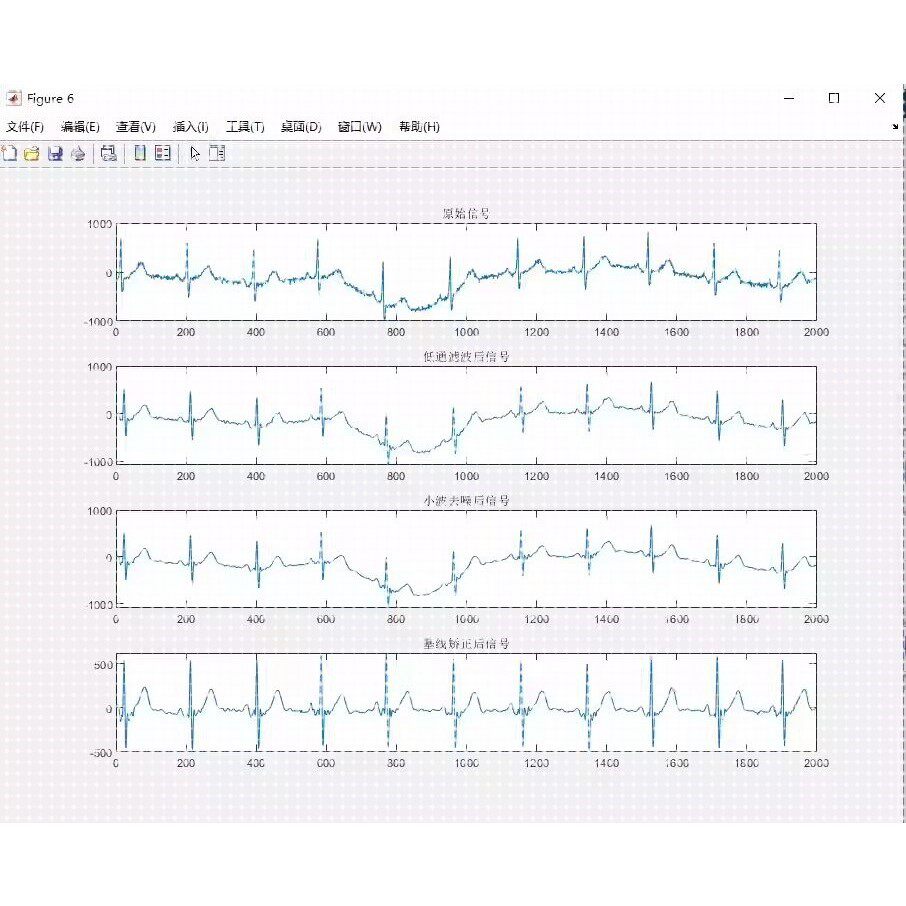 心电信号ECG去噪Matlab程序使用低通滤波和小波分解结合