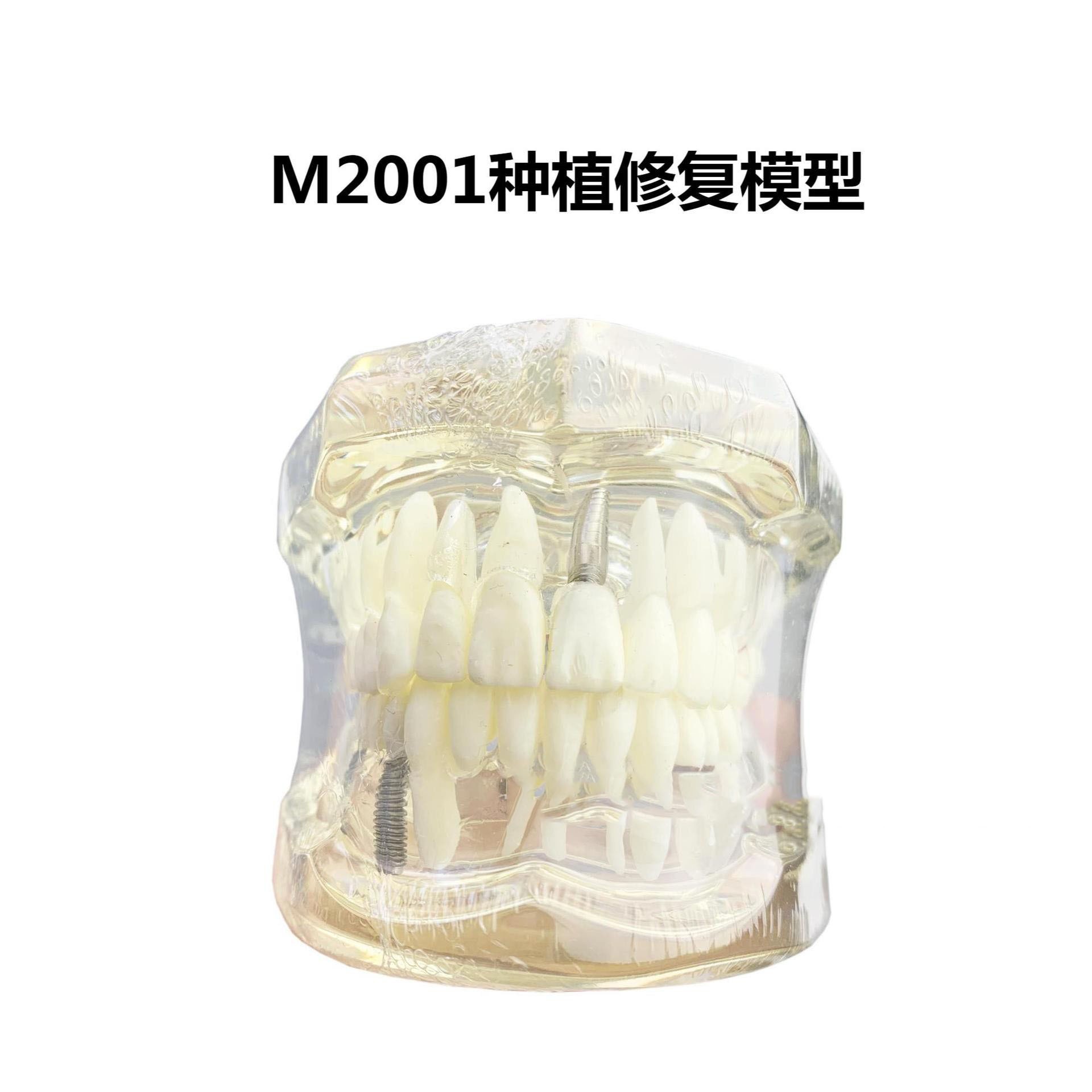 M2001病理模型牙齿模型备牙嵌体龋齿模型种植模型牙齿可拆卸