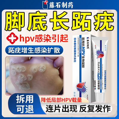 藤石制药hpv感染脚底跖疣硬疙瘩