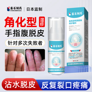手指角化型湿疹搭手癣膏脱皮干裂真菌感染慢性角质化皲裂性手部LQ