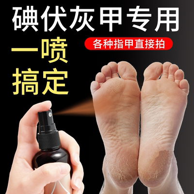 碘伏喷雾灰指甲安全性高医用