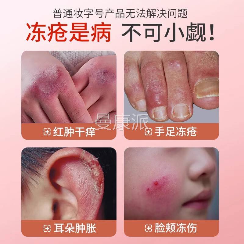 脸正品冻膏止耳痒冻疮伤朵部消QQO肿儿童干裂修复防冻护手霜凡士