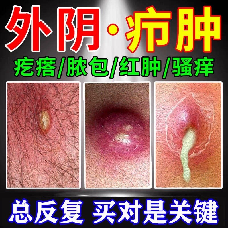 外阴疖肿拔毒膏火疖子药膏拔脓膏
