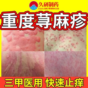 寻荨麻疹过敏止痒断急性丘疹性胆碱性荨麻疹进口根提高免疫力药膏