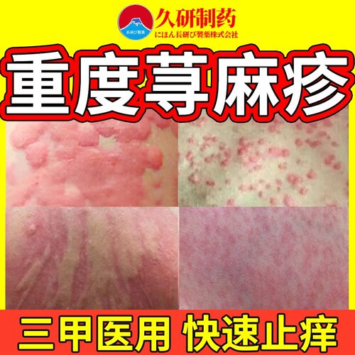 寻荨麻疹过敏止痒断急性丘疹性胆