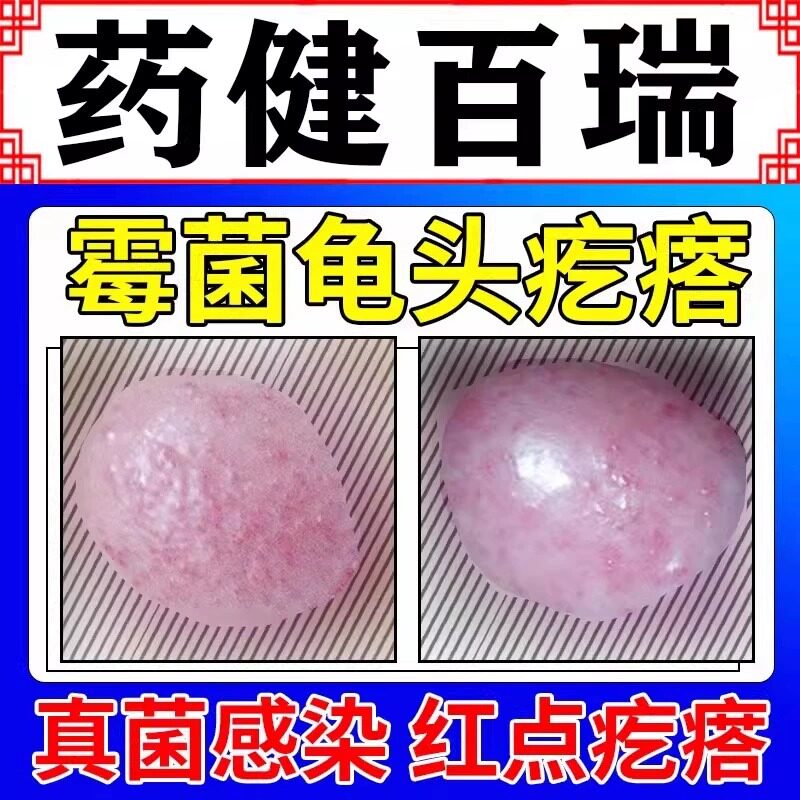 男性龟头炎真菌感染霉菌型症专用念珠菌性上有小红点疙瘩小颗粒GX