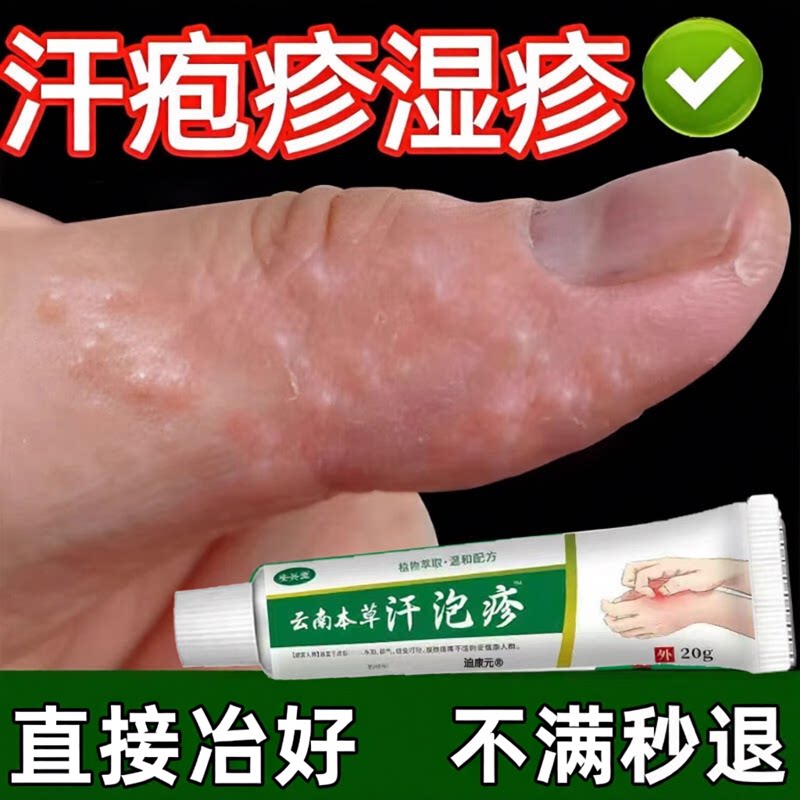 手上起小水泡汗泡疱止抑菌痒鹅掌风真菌感染手气湿痒疹特专效用膏