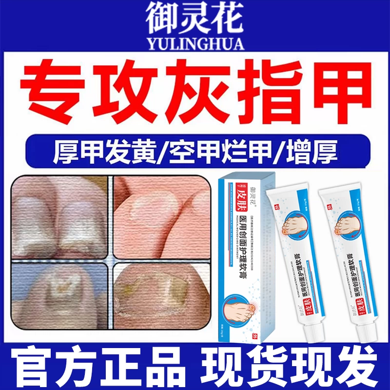 御灵花医用创面护理软膏灰指甲抑菌敷料甲沟炎疼痛化脓红肿旗舰店