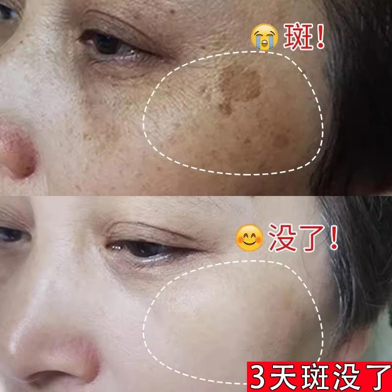 祛脸上黑点斑点 斑迹 脸上干干净净 跟斑点说拜拜~