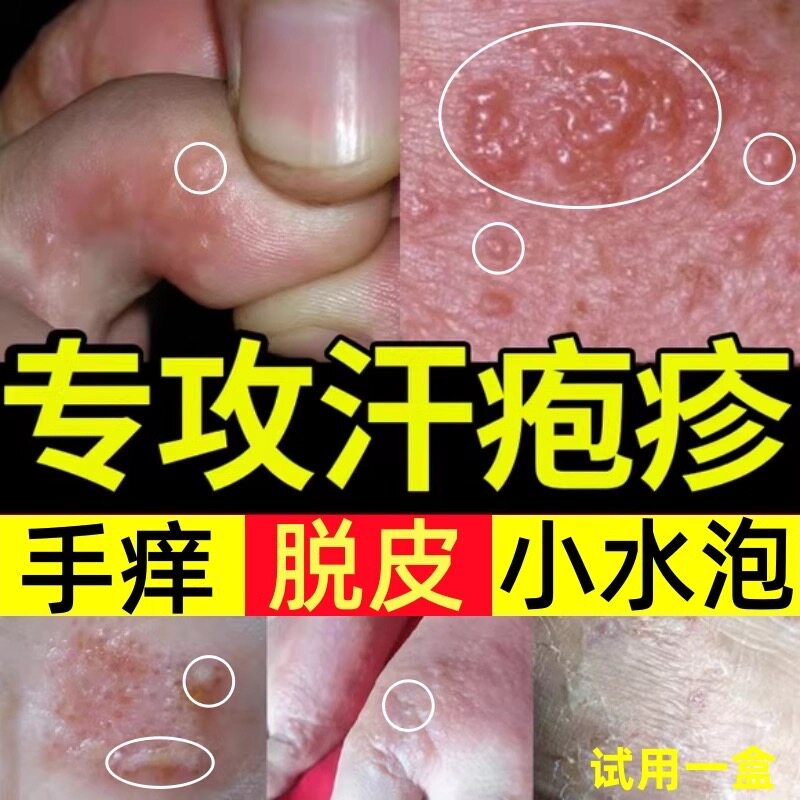 日本汗泡疱疹止痒药膏手上起小水泡汗状疱疹止痒干裂脱皮瘙痒药膏