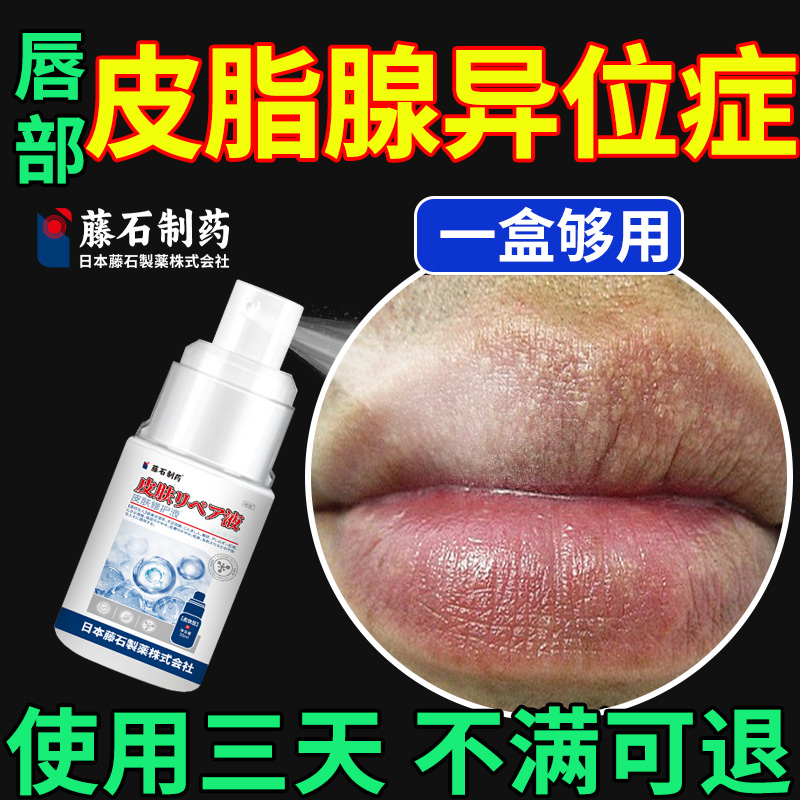 皮脂腺异位症修护嘴唇白点