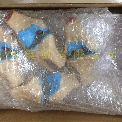 病态 膝关节模型 四阶段病理膝关节模型 病变 人体膝关节模型