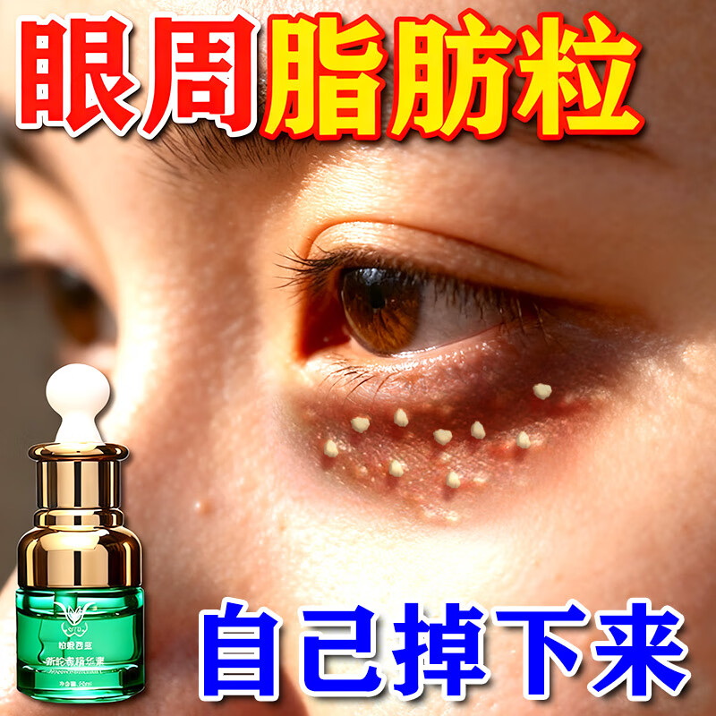 眼部脂肪颗粒眼霜油脂汗管瘤眼周眼角男女士膏去除神器专用旗舰店