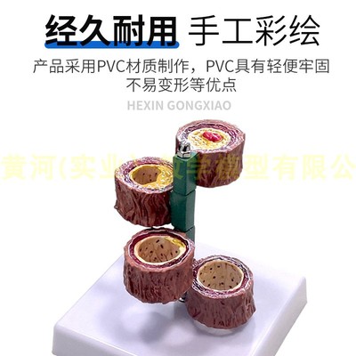 血栓人体支脉/粥样/血管模型 硬化 心血管动脉模型 心内科教学