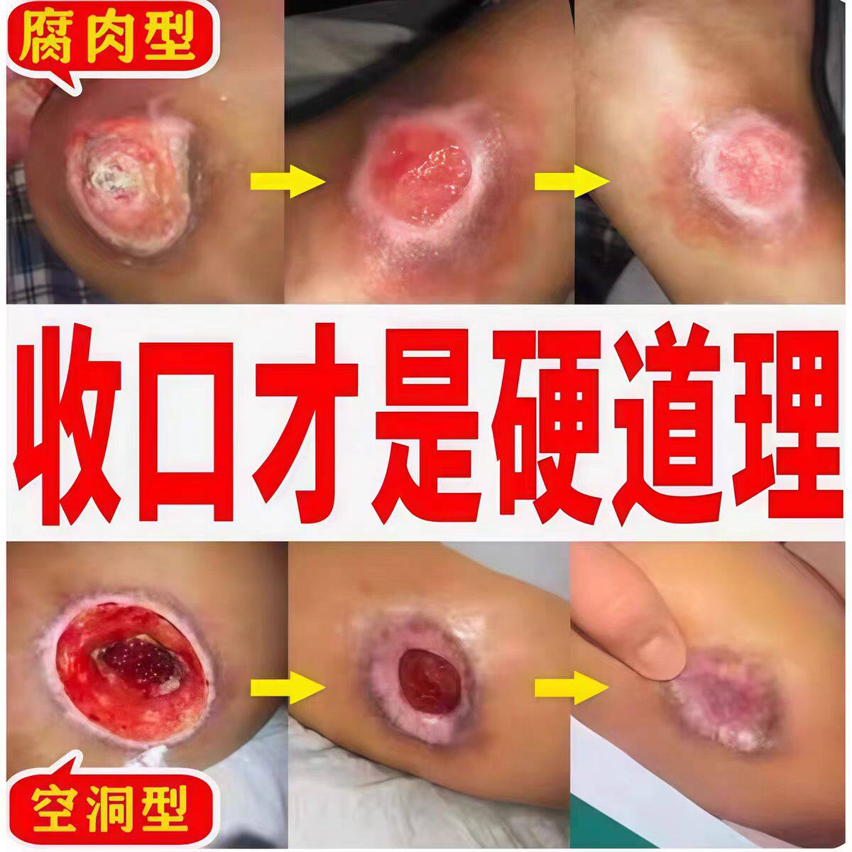褥创膏老臀部人皮肤溃烂外用伤口空洞压疮黑痂型愈合溃烂