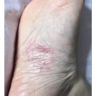 脚底板手掌心大痒杀菌脚底起皮脚臭汗开裂抗真脱皮药水泡型烂脚丫