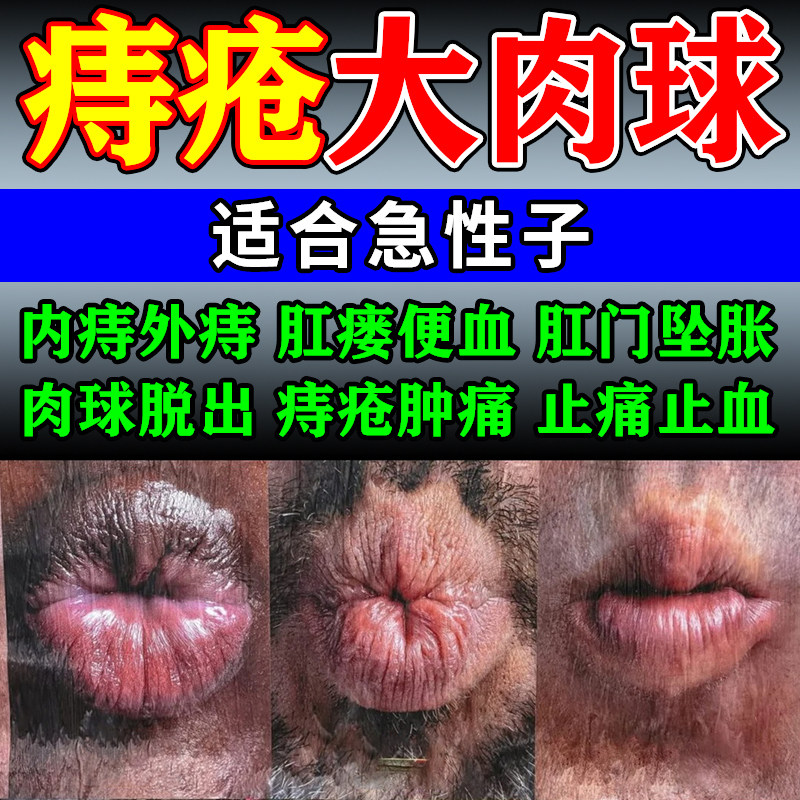 比尔小蓝痔疮膏消肉球痔根非断正品消痔凝胶断痣舒官方旗舰店女性