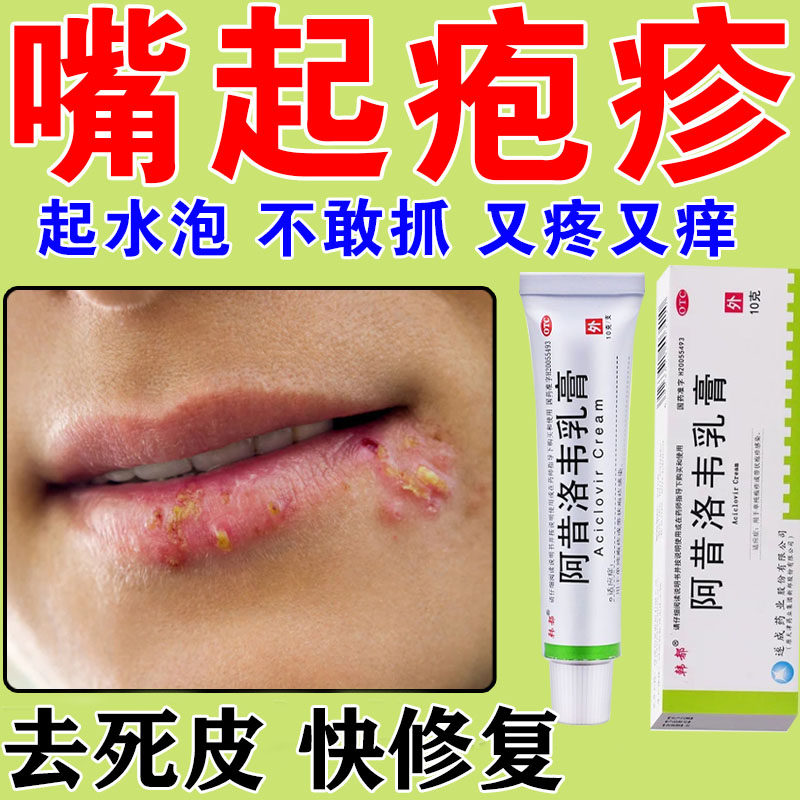 阿昔洛韦软膏乳膏疱疹特新效药嘴唇口唇嘴巴上火起泡烂嘴角疱疹膏