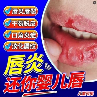 唇炎专用药膏嘴唇干裂脱皮治学生儿童医用唇膏急性皮炎皮肤溃疡S