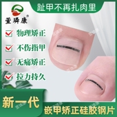甲沟嵌甲矫正钢丝贴片矽胶加钛合金片双效结合快速纠正趾甲矫正器
