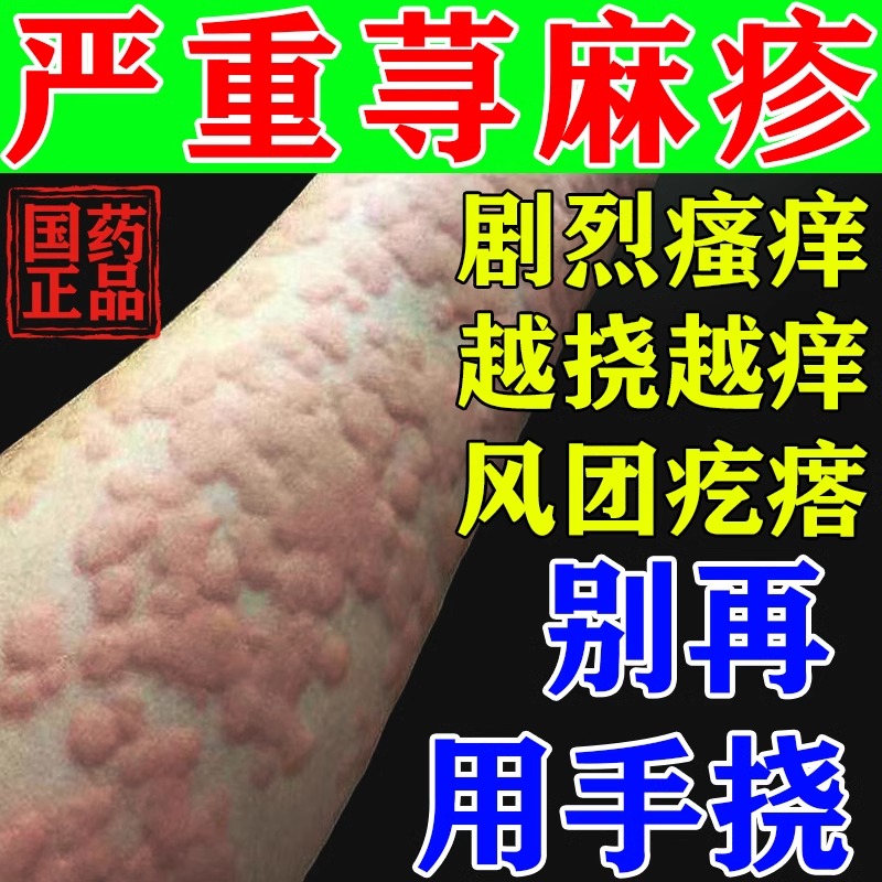 抗过敏药寻荨麻疹过敏止痒专用药扑尔敏过敏药皮肤瘙痒口服药
