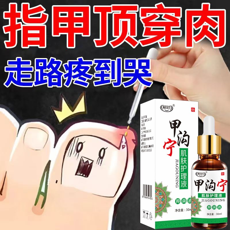 指甲沟勾炎特效去除息肉专用液脚趾甲往肉里长肉芽嵌甲软化剂药水