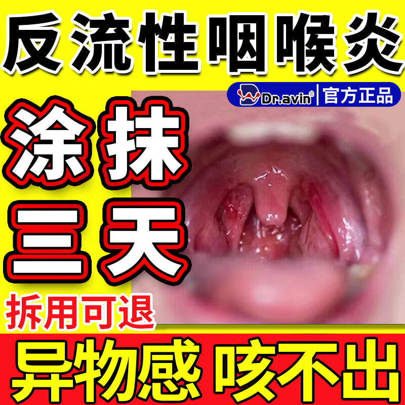 反流性咽喉炎异物感专用喉咙慢性咽炎滤泡增生咽炎嗓子老有痰CS