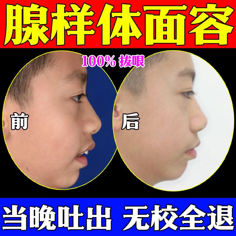 腺样体肥大面容矫正器儿童睡觉打呼噜张嘴呼吸嘴唇上翘调理中药贴