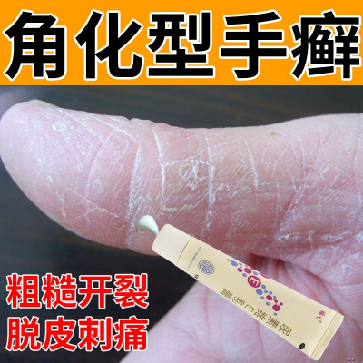 尿素维e软膏正品角化型湿疹手癣膏脱皮干裂真菌感染鹅掌风抑菌膏