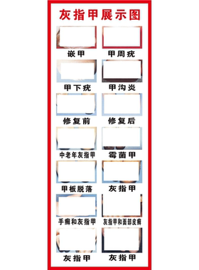 甲沟炎海报甲沟炎危害修脚养生广告宣传画足疗馆墙贴装饰海报图