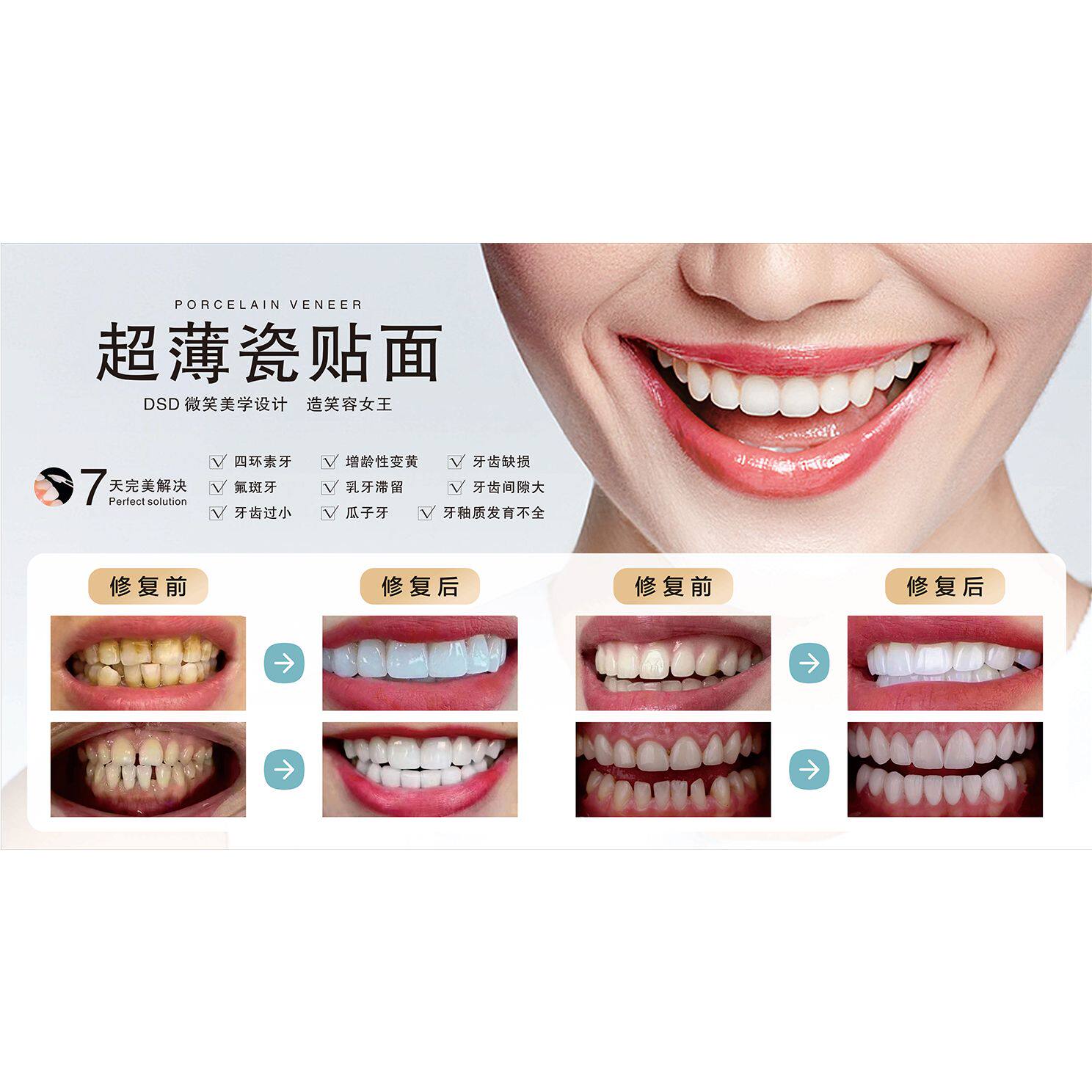 瓷贴面海报美白牙齿广告宣传画全瓷牙写真挂图6D纳米美牙齿整形图