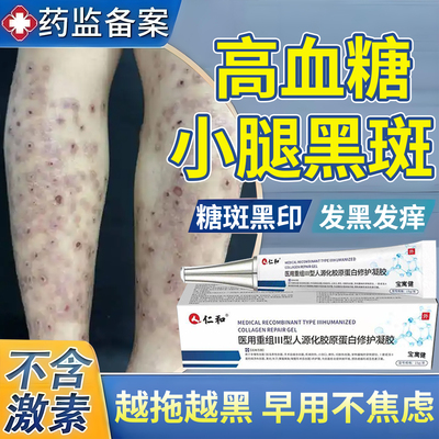 糖尿病疤痕印引起小腿黑斑去胫前除腿上糖斑皮肤痒色素沉着烂足膏