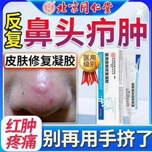鼻子头上长痘痘鼻头鼻尖红肿火疖子毛囊炎肉疙瘩长脓包型去的药膏
