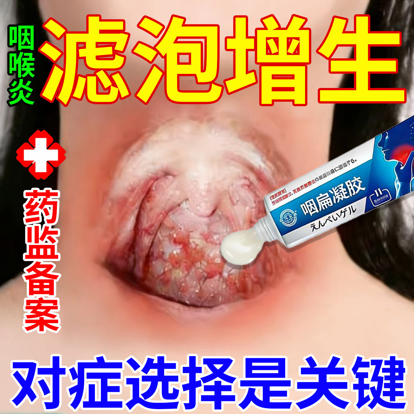 治疗咽喉炎慢性咽炎根专除用异物感咳嗽嗓子有痰喉咙滤泡增生淋巴