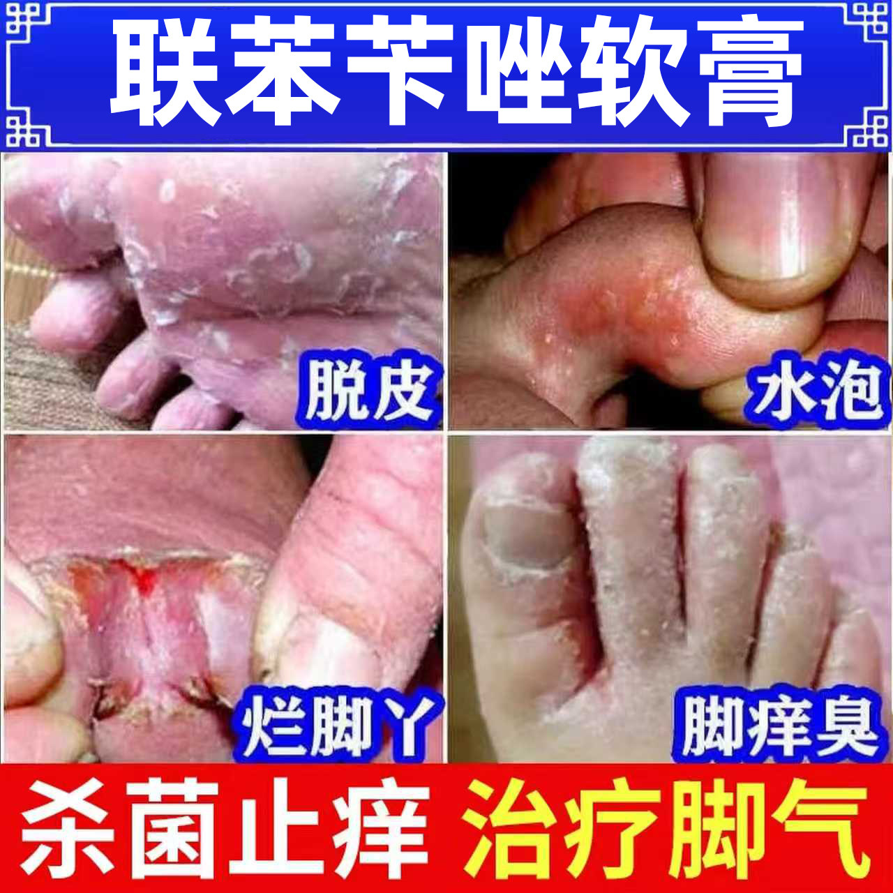 联苯苄唑乳膏软膏正品药膏去脚气真菌感染药烂脚丫药脱皮糜烂脚趾