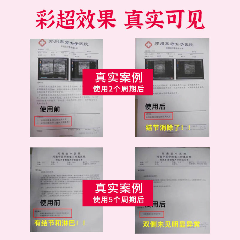 一夜就消】乳腺有结节乳房肿胀硬块小叶增生纤维瘤乳腺散结贴